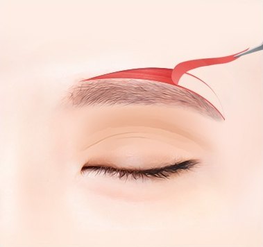 Hình minh họa quá trình phẫu thuật nâng cung mày trên: rạch phần da phía trên lông mày và cắt bỏ phần mô chùng nhão