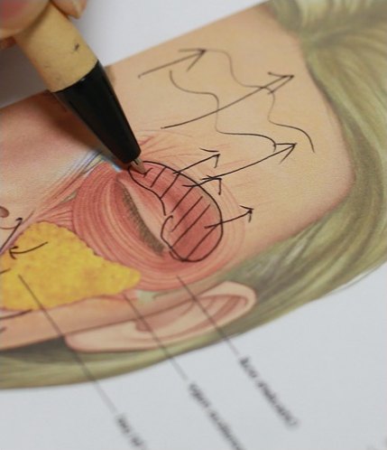 눈썹거상술 수술 계획을 위해 얼굴 근육 해부학 일러스트 위에 볼펜으로 절개선과 당김 방향을 표시하는 모습