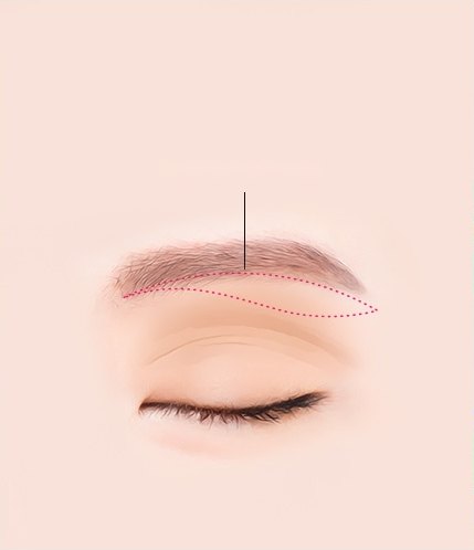감은 눈 위 눈썹 아래 라인을 따라 절개 범위를 붉은 점선으로 표시한 눈썹하거상술 절개 디자인 일러스트