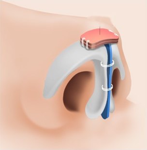 비중격 지지대와 콧날개 연골 위에 자가조직 이식편을 얹어 고정한 코끝 성형 수술 과정 일러스트