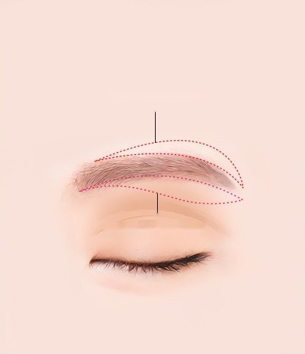 감은 눈 위 눈썹의 위쪽과 아래쪽 절개선을 붉은 점선으로 표시한 눈썹거상술 수술 도해