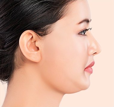 턱선과 이중턱 부위의 처짐 상태를 확인하는 여성의 우측 얼굴 옆모습 실리프팅 시술 전 단계