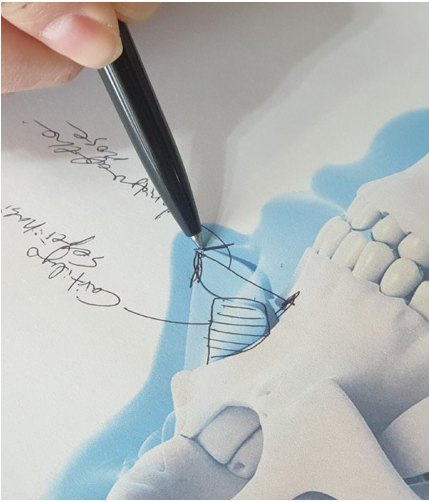 تخطيط لتصميم خطوط الجراحة ومواقع الغضاريف بالقلم فوق رسم هيكل عظام الوجه للتخطيط لعملية تجميل الأنف للرجال