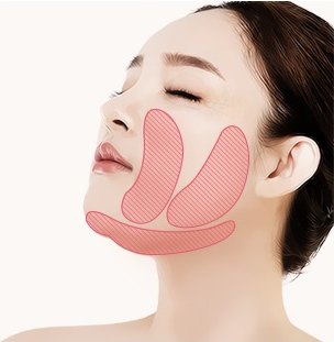 눈을 감은 여성의 볼과 이중턱 부위에 빗금으로 시술 부위가 표시된 얼굴 지방흡입 가이드 도해