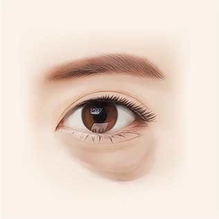눈 밑 지방이 크게 돌출되고 눈물고랑이 처진 50대 눈밑지방재배치 적용 대상 일러스트