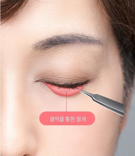 눈을 감은 눈꺼풀 안쪽 결막 절개 부위를 붉은 점선으로 표시하고 '결막을 통한 절개' 문구가 표기된 결막 눈밑지방재배치 수술 방법 도해