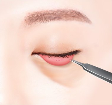 결막 눈밑지방재배치 과정 중 아래 눈꺼풀 안쪽 결막 부위를 의료용 기구로 접근하는 수술 과정 일러스트
