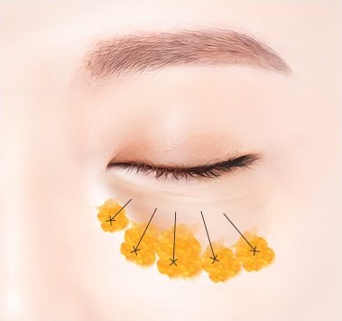 감은 눈 아래로 눈밑 지방 덩어리를 꺼진 부위로 고르게 펼쳐 재배치하는 과정을 화살표로 나타낸 결막 눈밑지방재배치 수술 도해