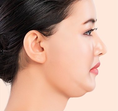 フェイスライン下と二重あご部位のたるみを確認する女性の右横顔とミニ切開リフトの適用部位