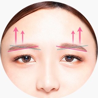 여성의 이마와 눈썹 부위에 위쪽 방향 화살표와 교차선으로 리프팅 방향을 나타낸 에이펙스성형외과 이마거상술 설명 도해