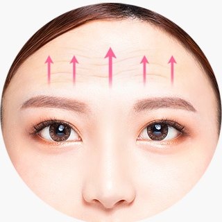 이마거상술 설명을 위해 여성의 이마 주름 부위에 위쪽 방향의 분홍색 리프팅 화살표를 표시한 도해