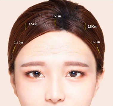 이마거상술을 위해 헤어라인 안쪽 다섯 군데에 1.5 Cm 절개 위치를 노란 점선으로 표시한 여성의 이마 부위 안내