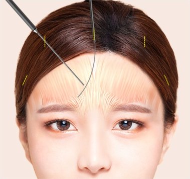 이마거상술 과정에서 두피 절개 부위로 내시경 기구가 삽입되어 이마 근육 부위를 박리하는 방식을 설명하는 도해