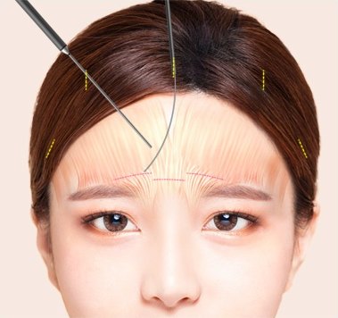 이마거상술 과정에서 내시경 기구를 삽입해 눈썹 위 근육과 절개 위치를 조절하는 모습을 나타낸 이마 도해