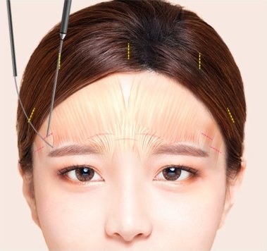 이마거상술 과정에서 눈썹 꼬리 쪽 인대 조직을 의료 기구로 박리하는 모습을 나타낸 도해