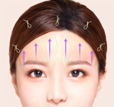 이마거상술 원리를 보여주는 도해로 여성의 이마에 위쪽을 가리키는 보라색 화살표와 헤어라인 부위의 고정 포인트를 나타낸 모습