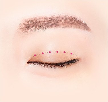 비절개 눈매교정 수술방법 안내로 눈꺼풀 위에 분홍색 점들과 점선으로 디자인 라인을 표시한 모습