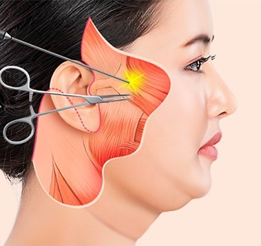 여성의 옆얼굴에 SMAS층과 안면 근육 해부도를 겹치고 수술 도구로 박리하는 SMAS안면거상 과정 도해
