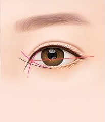 눈 앞머리 몽고주름과 눈매 각도를 붉은색과 검은색 가이드선으로 분석하는 눈성형 정밀 분석 일러스트