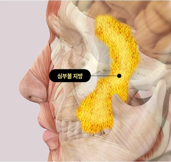 رسم توضيحي من عيادة APEX لجراحة التجميل لإزالة دهون الخد العميقة يشير إلى كتلة دهون الخد العميقة الصفراء داخل الخد في مخطط تشريح الوجه