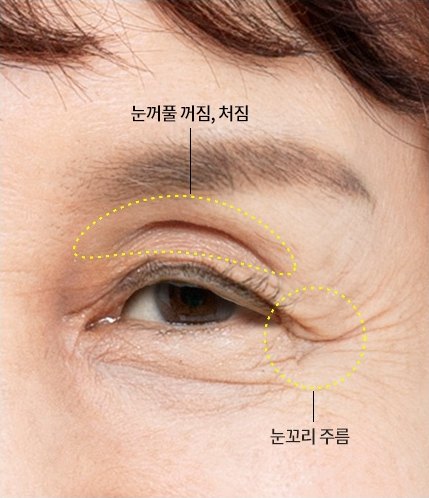 Cận cảnh mắt người phụ nữ trung niên với các đường nét đứt đánh dấu vùng mí mắt bị trũng, chùng nhão và nếp nhăn đuôi mắt để chẩn đoán nâng cung mày trên và thẩm mỹ mắt tuổi trung niên