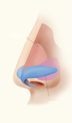 무보형물 코성형 시 비중격과 날개연골 등 내부 코 연골 구조를 색상으로 구분해 보여주는 코 측면 해부도 일러스트