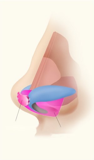 무보형물 코성형 시 코끝에 연골을 이식하고 비주 지지대를 보강하는 과정을 나타낸 측면 해부학 일러스트