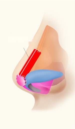 무보형물 코성형 시 콧등과 코끝 부위에 자가연골을 이식하고 고정한 코 측면 내부 구조 단면도