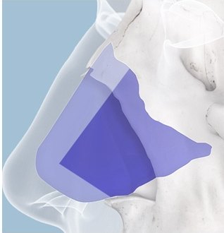 무보형물 코성형 시 채취 및 활용 부위를 설명하기 위해 코 내부 연골과 비중격 위치를 보라색 영역으로 표시한 해부학 도해