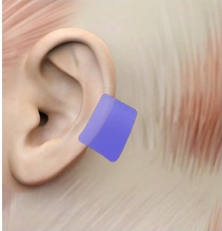 무보형물 코성형에 사용되는 귀 뒤쪽 근막 자가조직 채취 부위를 보라색 사각 영역으로 표시한 귀 주변 해부도