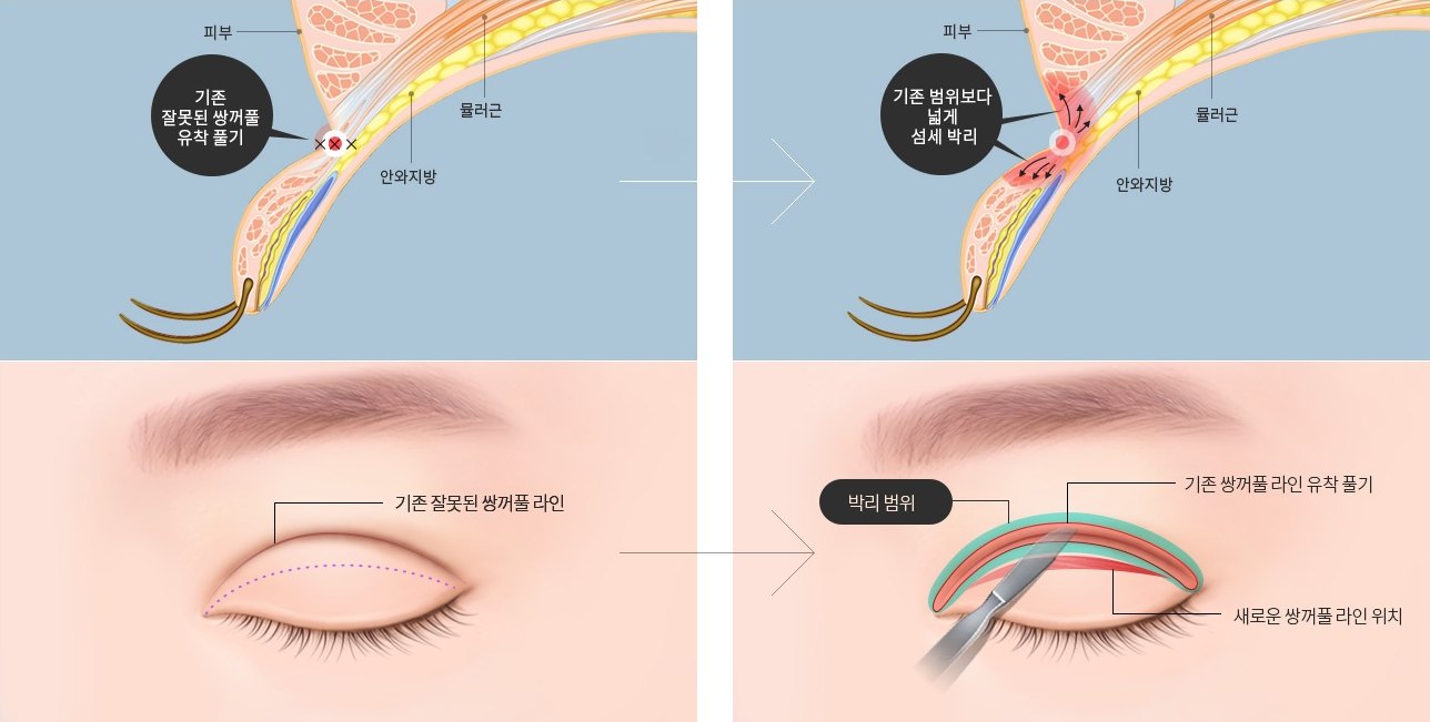 기존 잘못된 쌍꺼풀 유착을 풀고 넓은 범위를 박리하여 새로운 쌍꺼풀 라인을 만드는 눈재수술 과정을 나타낸 의학 도해
