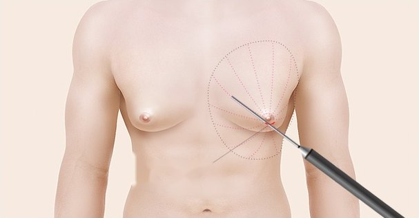 남성 가슴 부위에 방사형 점선으로 지방흡입 범위를 표시하고 유륜 아래로 캐뉼라를 삽입하는 여유증 수술 과정 도해