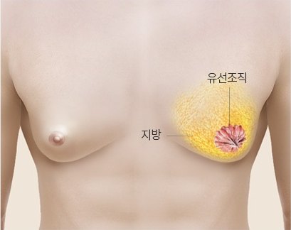 남성 가슴 내부의 지방과 유선조직 위치를 설명하는 여유증 구조 일러스트
