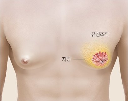 남성 가슴 내부의 지방과 유선조직 위치를 설명하는 여유증 구조 안내 도해