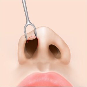 비개방 코성형 수술을 위해 수술 도구로 콧구멍 안쪽을 벌리고 절개선을 표시한 일러스트
