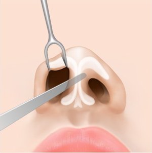 낮은코 성형 비개방형 수술 과정에서 기구를 이용해 콧속 절개창을 벌리고 콧망울 연골 부위를 박리하는 도해
