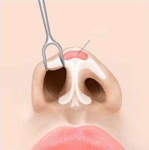 비개방형 절개 낮은코 성형 수술에서 콧구멍 안쪽을 기구로 들어 올리고 코끝 부위에 보형물을 삽입하는 과정을 보여주는 일러스트
