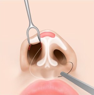 비개방 코성형 수술에서 콧구멍 안쪽 절개 부위를 실과 기구로 정교하게 봉합하는 과정 일러스트