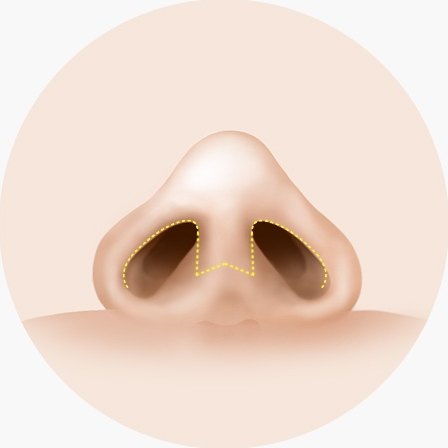 낮은코 성형 시 코 아랫면 비주와 콧구멍 안쪽을 절개하는 개방형 절개선을 노란색 점선으로 표시한 일러스트