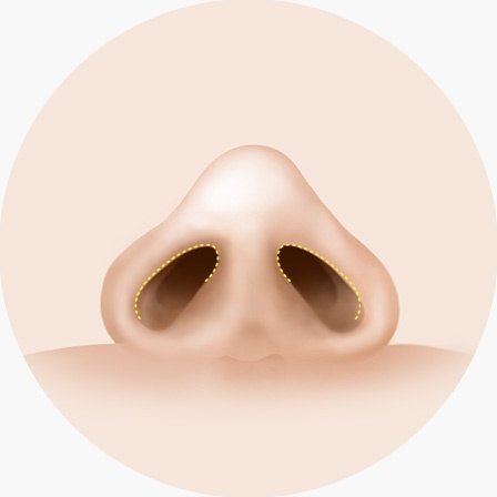 비주 절개 없이 콧구멍 안쪽 점막을 따라 절개선이 표시된 낮은코 성형 비개방형 절개 도해