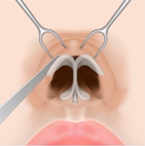 낮은코 성형을 위한 개방형 코수술 시 수술 기구로 코 피부를 들어 올리고 코끝 연골을 노출 및 박리하는 과정 도해