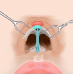 낮은코 성형 시 비주 지지대와 코끝 연골을 배치하여 지지 구조를 만드는 개방형 코수술 도해