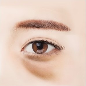 하안검 수술 전 눈 밑 피부의 처짐과 불룩하게 튀어나온 지방 및 그늘을 표현한 눈가 일러스트