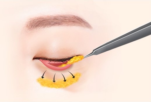 하안검 수술 과정에서 눈꺼풀 안쪽 결막을 통해 돌출된 눈 밑 지방을 아래쪽으로 재배치하는 방법을 보여주는 의학 일러스트