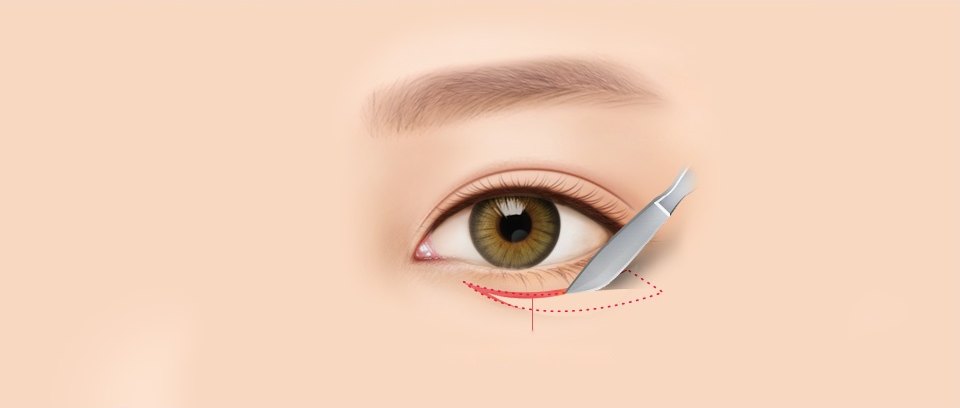 하안검 수술을 위해 아래 속눈썹 라인을 따라 절개선과 절제 범위를 점선으로 디자인하고 수술용 메스로 절개하는 일러스트