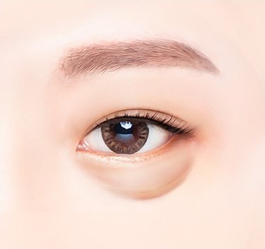 하안검 수술 전 눈 밑 지방이 불룩하게 튀어나오고 주름진 눈 부위 일러스트