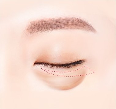 하안검 수술을 위해 감은 눈의 아래 속눈썹 라인과 눈 밑 처진 피부를 따라 빨간색 점선으로 절개 부위를 디자인한 도해