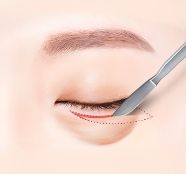 하안검 수술을 위해 메스로 아래 속눈썹 바로 밑 피부를 절개하는 과정을 보여주는 수술 단계 일러스트