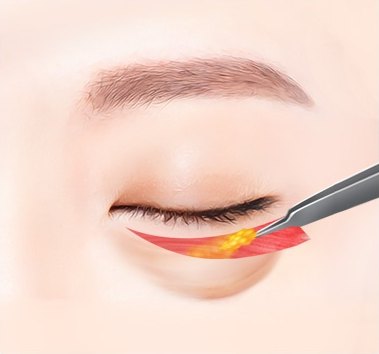하안검 수술 중 아래 눈꺼풀 아래 절개 부위에서 은색 겸자로 돌출된 눈 밑 지방을 제거 또는 재배치하는 과정을 나타낸 도해