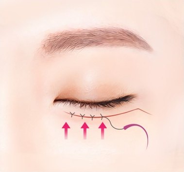 하안검 수술 과정에서 눈 밑 속눈썹 라인을 따라 피부를 위쪽으로 당겨 봉합하는 단계를 나타낸 도해